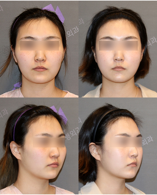 Anesthesia Accidents in Facial Contouring Surgery, Death Cases - Explained by a Plastic Surgery Specialist image 3