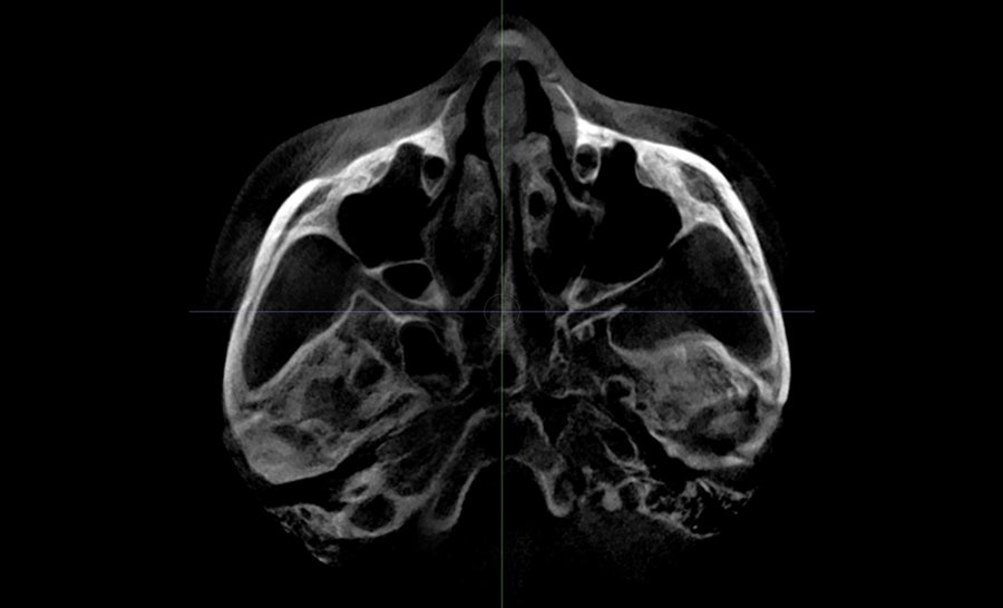 Is Pin Removal Surgery Necessary in Facial Contouring? Titanium Fixation Pins vs. Absorbable Fixation Pins image 4