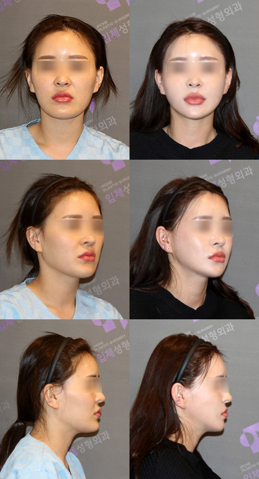 주걱턱은 어떤 수술을 해야 할까요? 관련 이미지 5