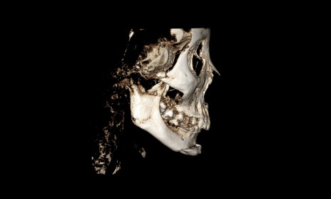 What Surgery Is Best for Correcting a Recessed Chin? The Limits of Chin Advancement Surgery and the Actual Results image 5