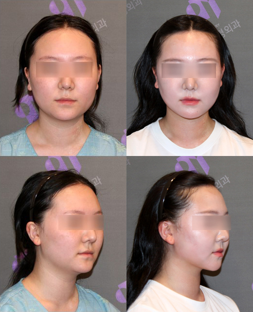광대수술과 볼패임 교정을 같이 할 수 있나요? 관련 이미지 3