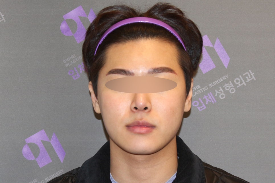 Male Cheekbone Reduction Surgery, Explained with Before-and-After Photos of Facial Contouring Surgery. image 3