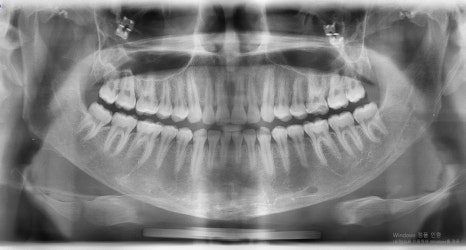 Which Surgery Do I Need: Contouring Surgery or Double-Jaw Surgery? image 12