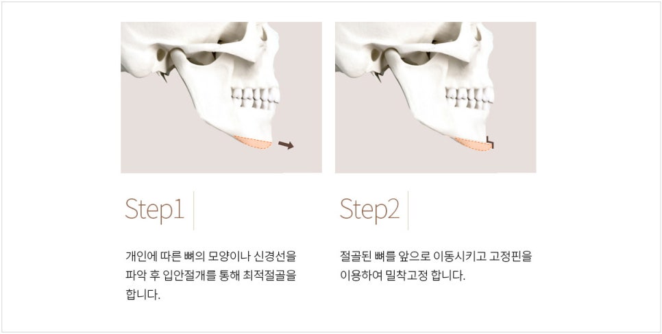 What Surgery Is Needed for a Long, Recessed Chin or a Short, Recessed Chin? image 6