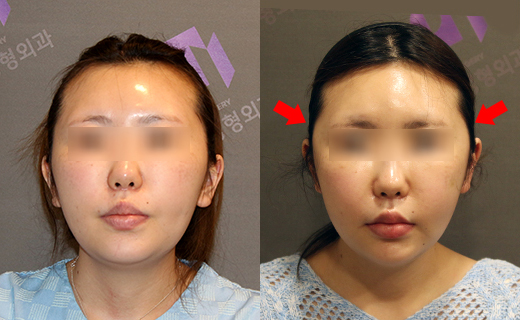 230도입체광대축소술이 일반 3D광대수술보다 더 좋은가요? 관련 이미지 4