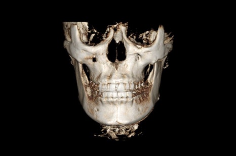 Are There People Who Can’t Have Cortical Ostectomy Surgery for a Frontal Square Jaw Effect? image 16