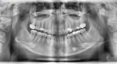 [Chin Surgery] Learning About Contouring Shaving and T-Osteotomy with Real Patient Cases (3) image 3