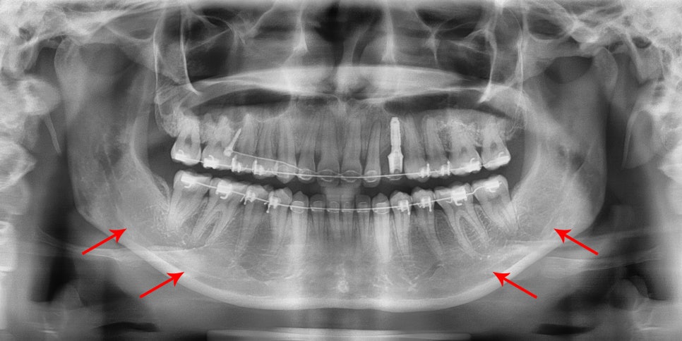 What Side Effects Can Occur After Chin Surgery? image 1