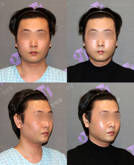 How effective is the incision method compared to the non-incision method for cheek hollow correction? image 7