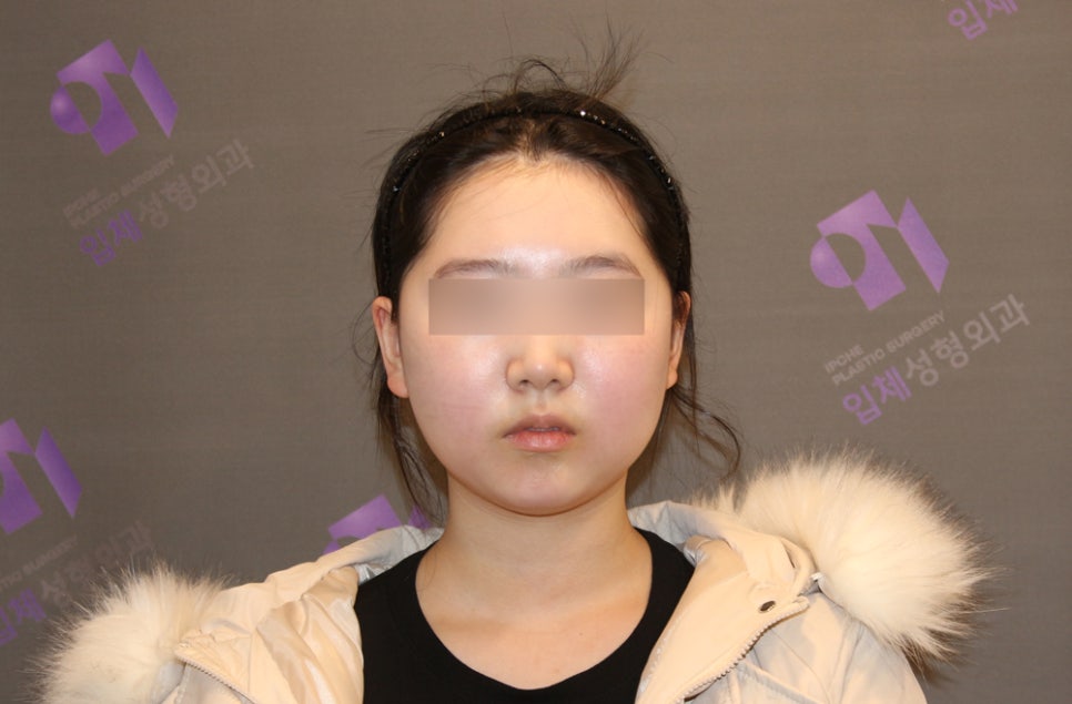 If the Face (Cheekbones) Is Asymmetrical, Can It Be Corrected with Cheekbone Reduction Surgery? image 7