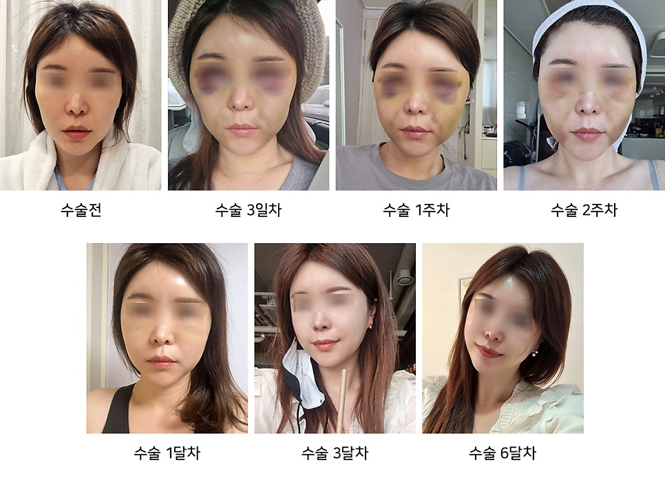 Is facial contouring surgery possible even at an older age? Important things you should know image 10