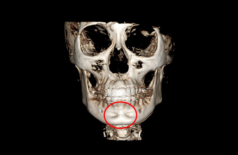 Does chin filler or an implant cause bone erosion? image 6