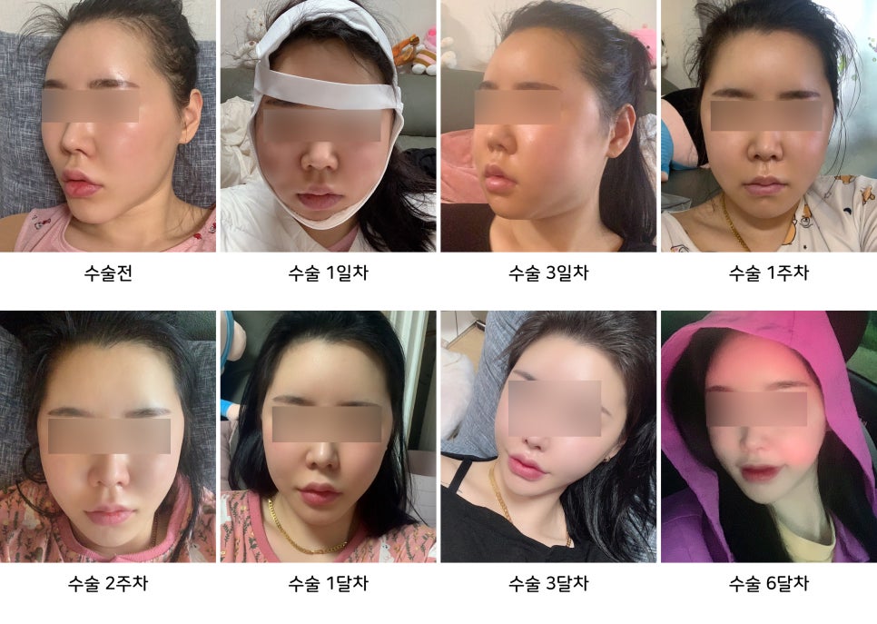 안면윤곽 수술 후 붓기와 회복기간, 케이스 바이 케이스 관련 이미지 3