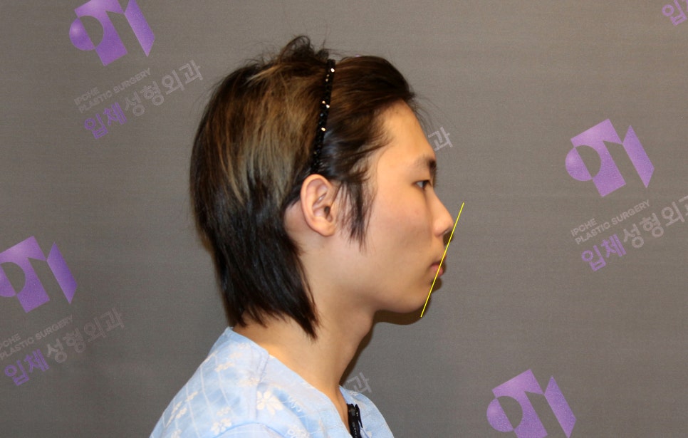 돌출입과 무턱은 윤곽수술로 교정이 가능할까요? 관련 이미지 2