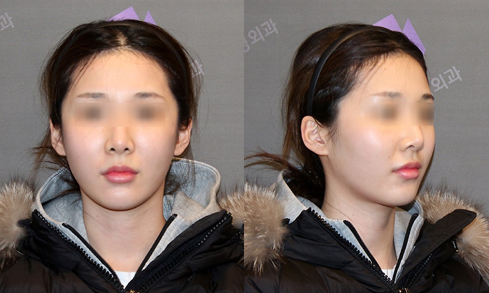 Does the Surgical Method Change Depending on the Protruding Cheekbone Location? Exact Locations and Diagnosis of the Front Cheekbone, Side Cheekbone, 45-Degree Cheekbone, and Back Cheekbone image 3