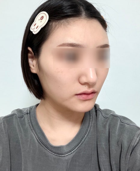 땅콩형 얼굴, 안면윤곽 수술로 해결할 수 있을까요? 관련 이미지 2