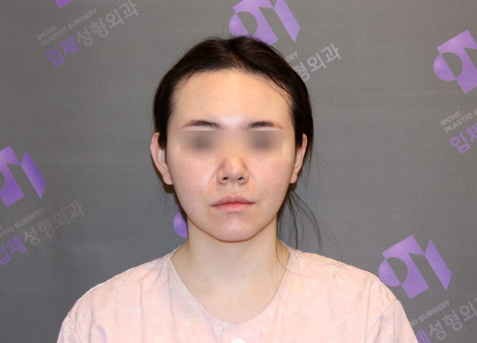 윤곽수술과 같이 하면 좋은 수술 : 귀족수술 관련 이미지 3