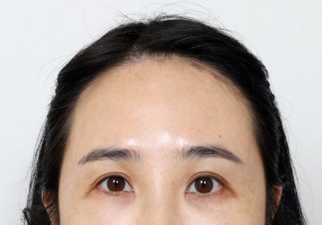 3D프린터 보형물을 이용한 안구함몰, 함몰눈 교정의 실제 사례 관련 이미지 11