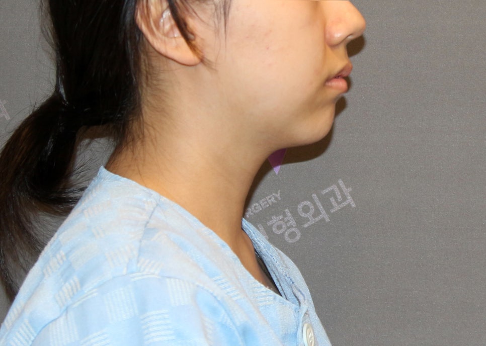 짧고 심한 무턱은 턱끝전진술로 개선이 가능할까요? 관련 이미지 7
