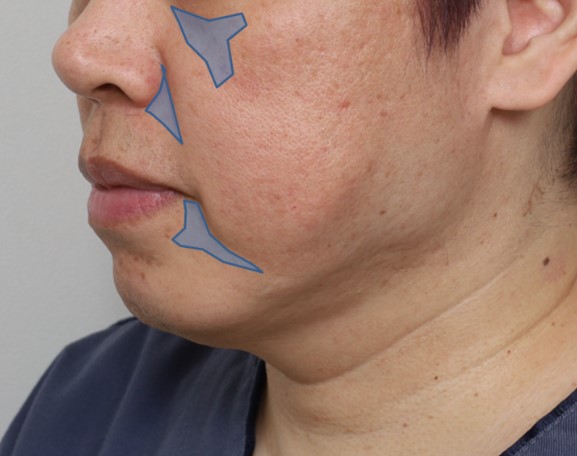 Amazing Changes Achieved with Contouring Facelift: A Facelift Technique That Even Addresses Asymmetry image 3