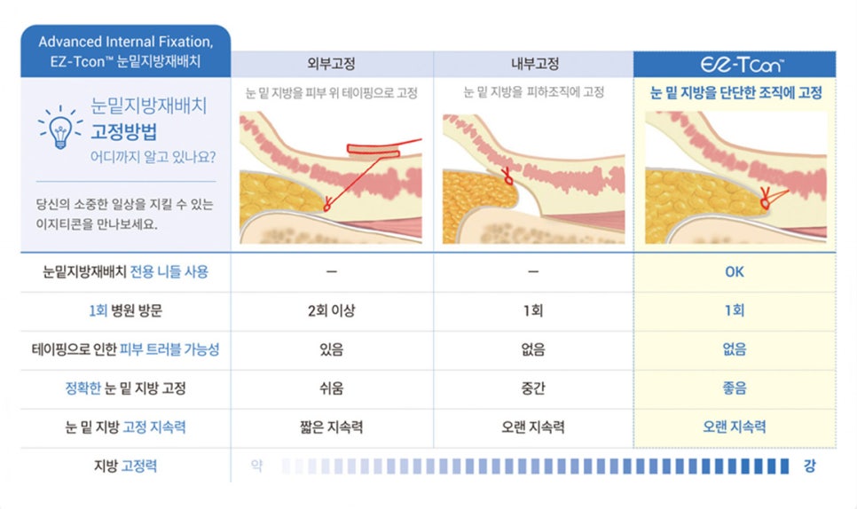 눈밑지방재배치와 하안검 수술이 어떻게 다른가요? 관련 이미지 4