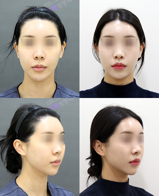 How Much Effect Does 230-Degree Zygoma Reduction Surgery Have? image 5