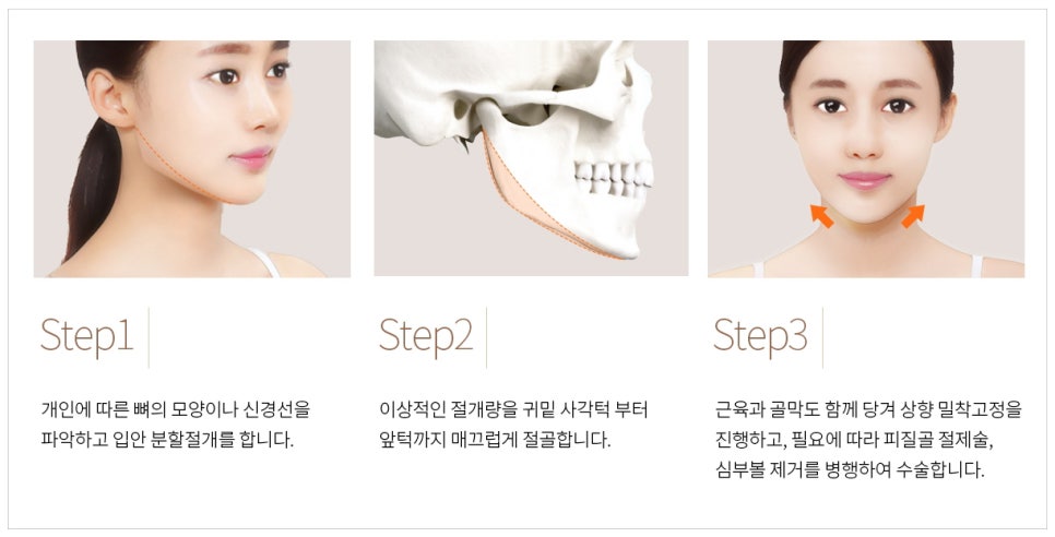 Facial Contouring A to Z: What Is Contouring Surgery? image 4