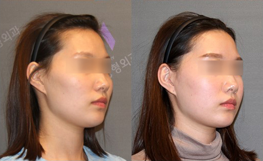 Cheekbone Reduction Surgery: A 2–3 mm Difference in the Side Cheekbones Makes a Big Change in the Face. image 6