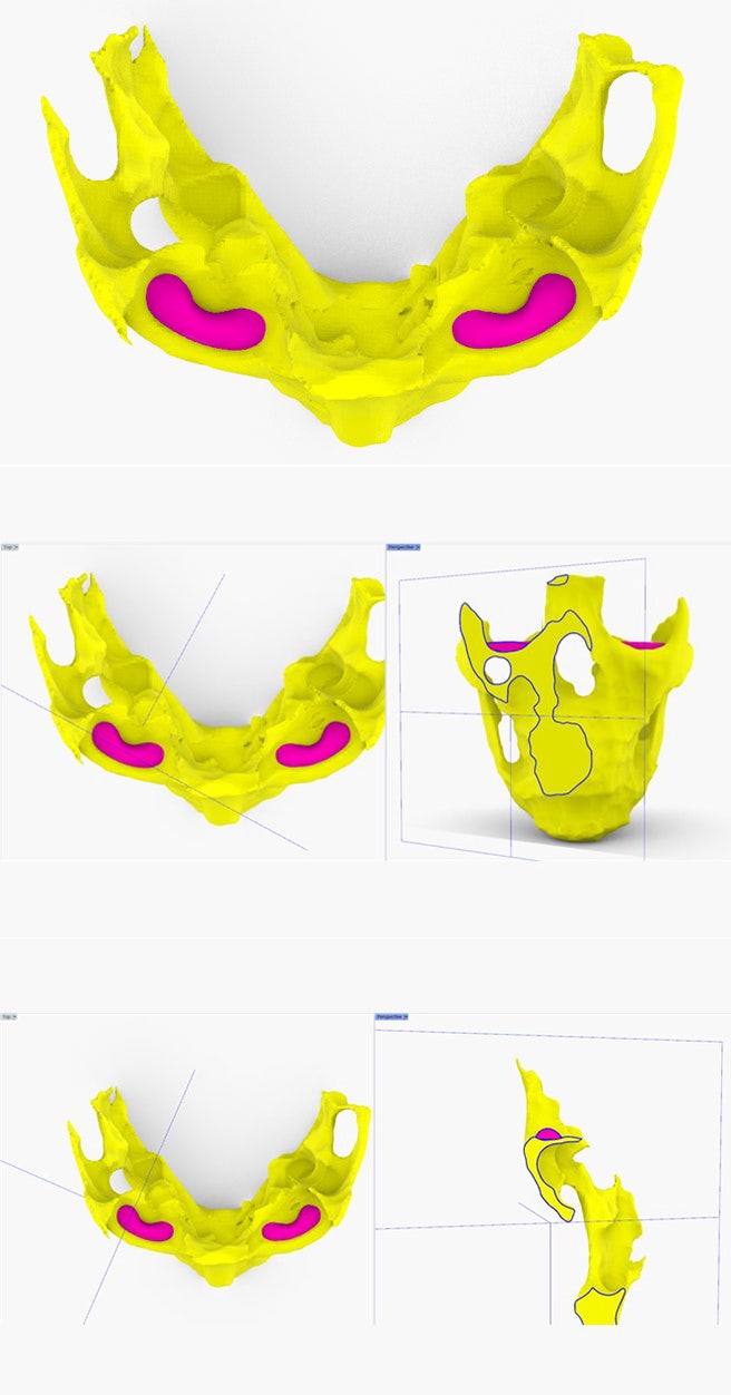 What Is the Best Way to Correct Deep-Set Eyes? image 7