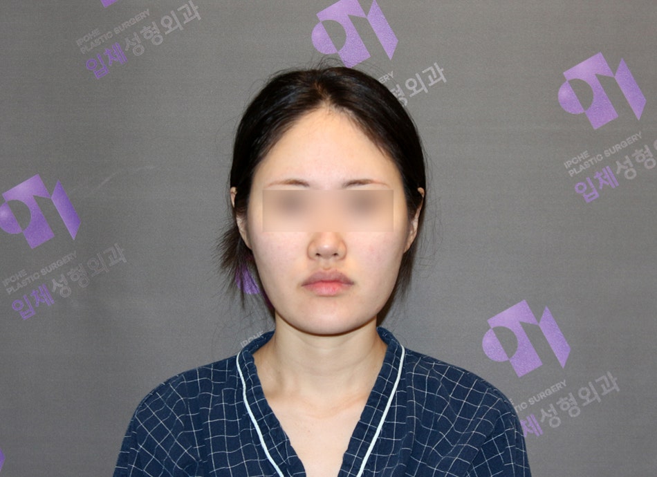 Square Jaw Surgery: The Difference Between Cortical Osteotomy and Lateral Cortical Shaving image 7