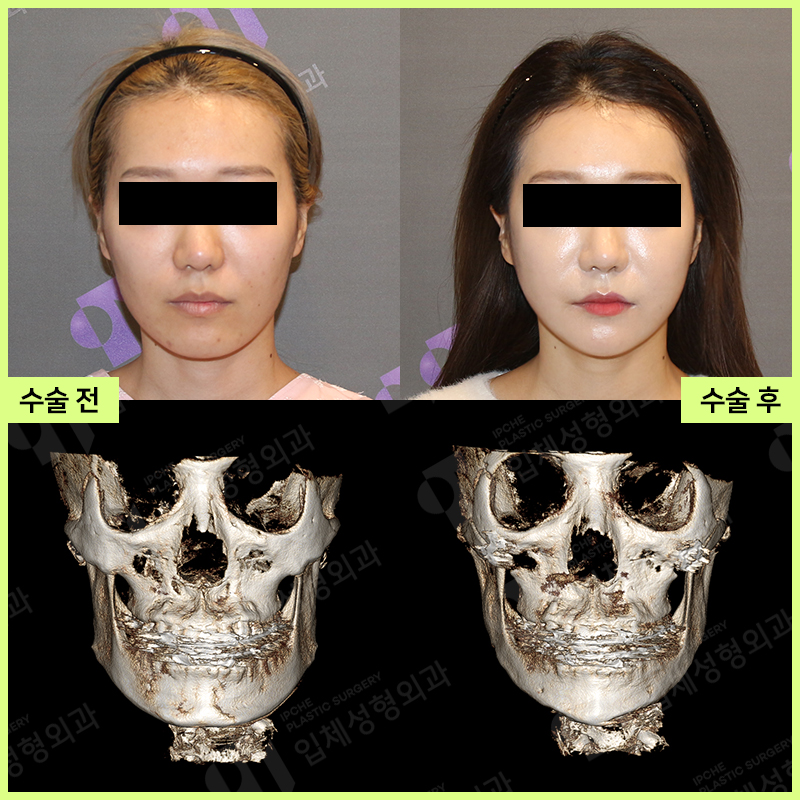 안면윤곽 수술 전 꼭 확인하세요! - 성형외과 전문의가 알려드립니다. 관련 이미지 5