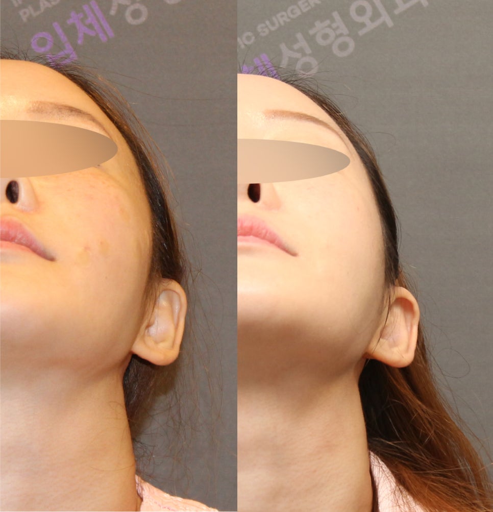 옆광대수술후기, 사례와 함께 알아보기 - 전문의가 직접알려드립니다. 관련 이미지 8