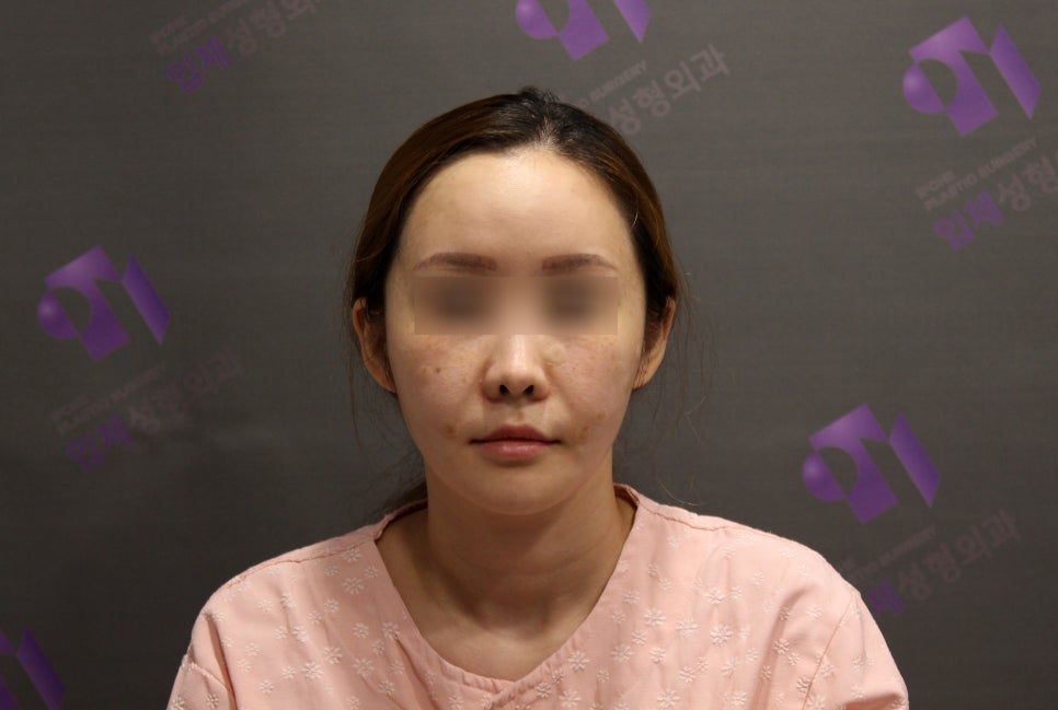 안면윤곽 볼처짐 100%온다? 광대수술 부작용 관련 이미지 6