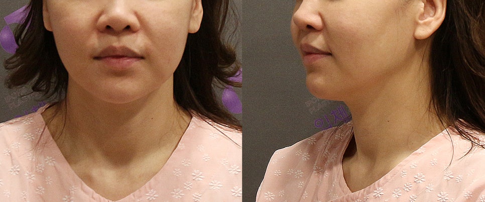 Facial Contouring Surgery image 5