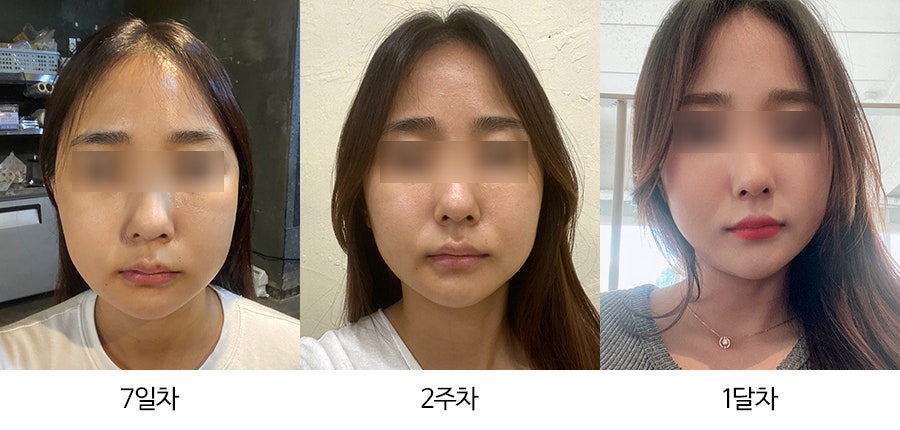안면윤곽수술 후 붓기, 일차별(1일~30일차)사진과 함께 회복기간 알아보기 관련 이미지 2