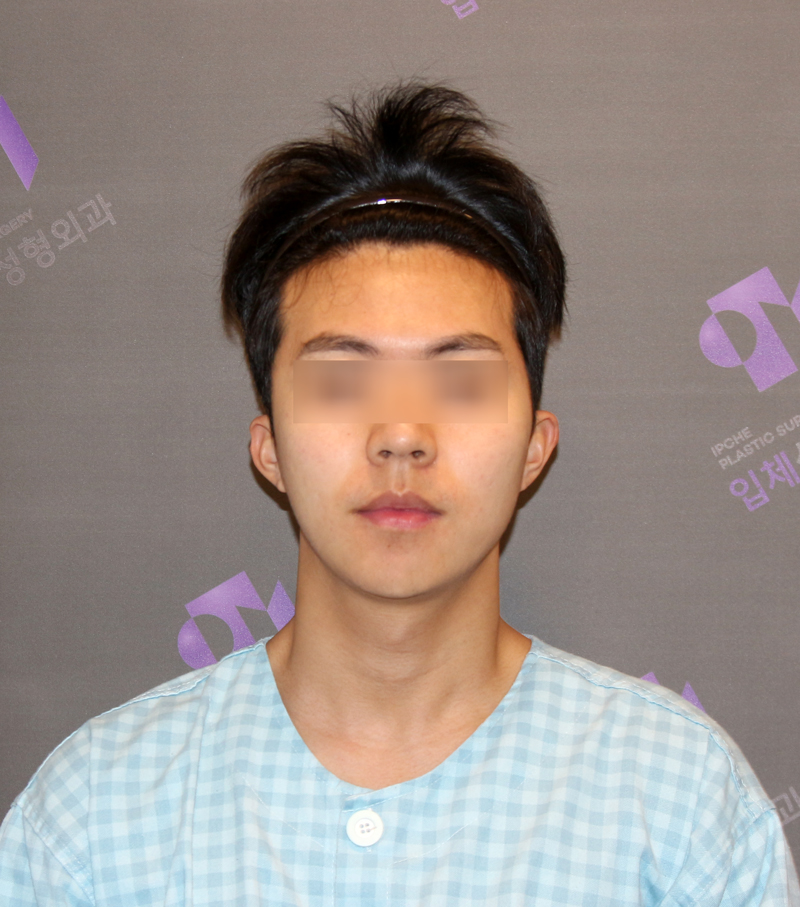 광대뼈 비대칭, 광대축소술로 교정할 수 있을까요? 관련 이미지 4