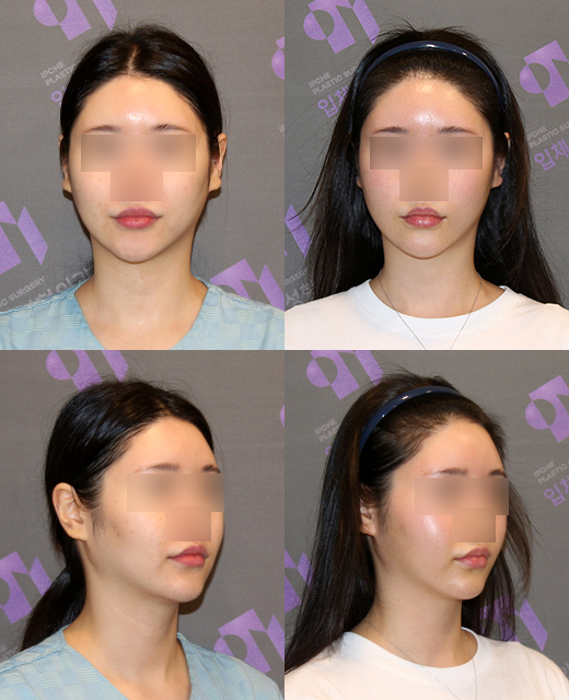 How effective is the incision method compared to the non-incision method for cheek hollow correction? image 2