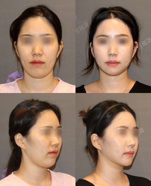 Will Zygoma Reduction Surgery Make Your Face Look Longer? - Explained by a Board-Certified Plastic Surgeon image 3