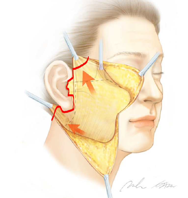 Is Fat Grafting Always Necessary When Undergoing a Facelift? image 2
