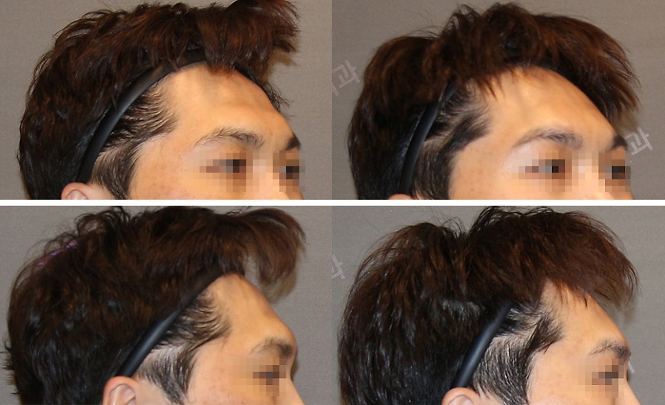 How Should Brow Bone Prominence Be Addressed? image 4