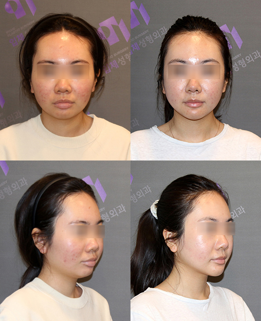 T-Genioplasty Techniques That Vary Depending on the Shape of the Chin image 6