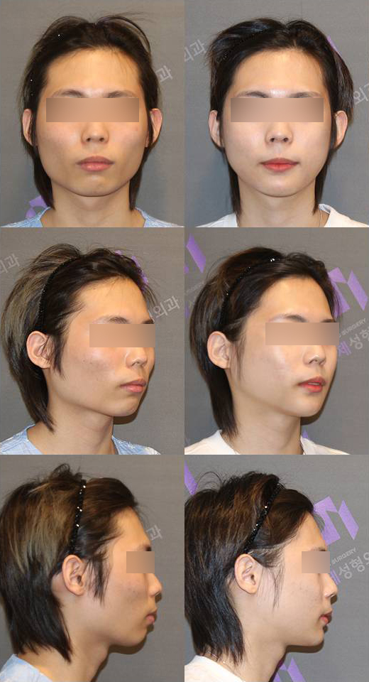 [긴턱/주걱턱교정] 돌려깎기와 턱끝T절골수술, 이차각 부작용은 왜 생기는 걸까요? 관련 이미지 9