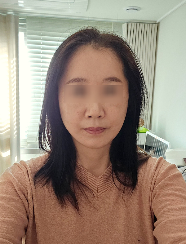 Facelift Recovery Period: When Will My Face Look Natural Again? image 4