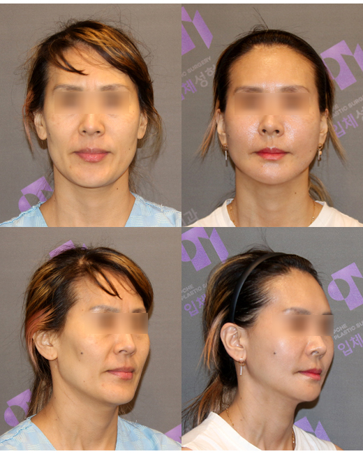 꺼진 얼굴 vs 처진얼굴 어떻게 해결해야 할까요? 관련 이미지 5