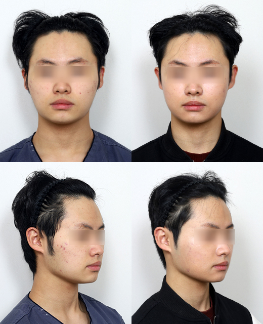남자광대축소술이 여자와 다른 이유는? 관련 이미지 6