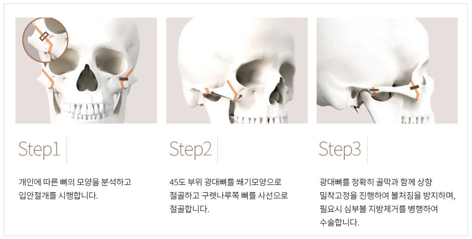Facial Contouring A to Z: What Is Contouring Surgery? image 1