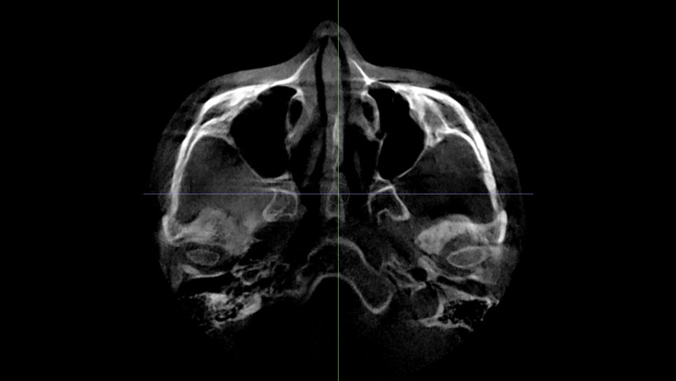 Back Cheekbone Shaving? Osteotomy? Do You Really Need It? image 5