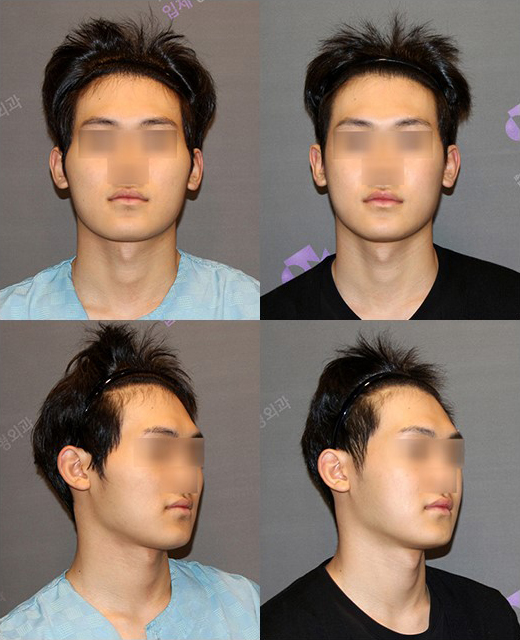 안면윤곽수술 후 신경손상 어떤 것이 있을까요? 관련 이미지 10