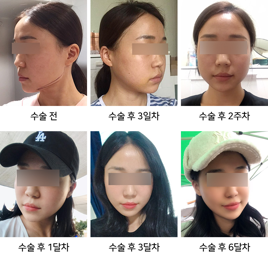 안면윤곽 붓기 빨리 빼는 법 총정리 - 성형외과 전문의가 알려드립니다 관련 이미지 3