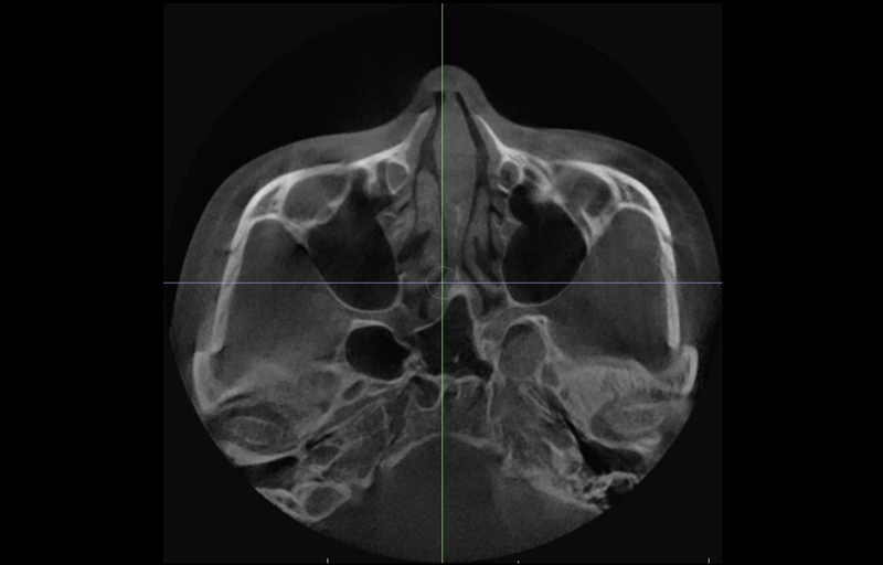 Will cheekbone reduction surgery also make the face smaller? : Learn about how to reduce prominent cheekbones with real surgical cases image 9